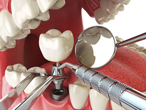 Best Dentist for Tooth Abscess  in Middletown, OH